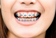 Crafting Confidence: The Psychological Impact of Braces on Self-Esteem