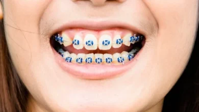 Crafting Confidence: The Psychological Impact of Braces on Self-Esteem