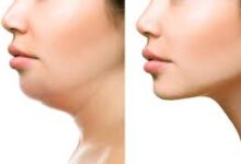 Double Chin Removal in Dubai