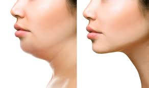 Double Chin Removal in Dubai