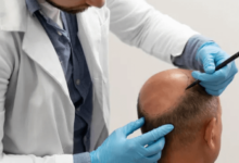 FUE, DHI & Robotic: New Hair Transplant Techniques That Make Results Look Amazingly Natural