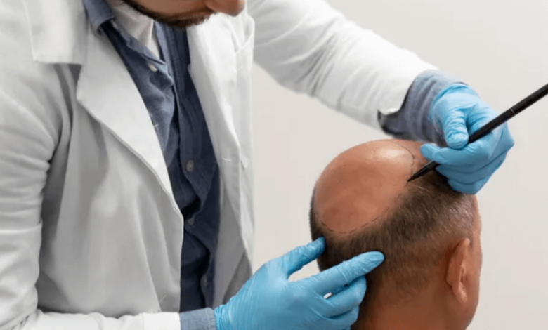 FUE, DHI & Robotic: New Hair Transplant Techniques That Make Results Look Amazingly Natural