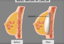 Implants