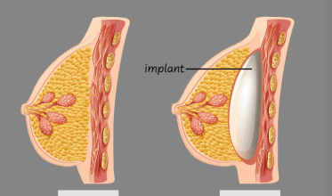 Implants