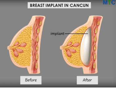 Implants